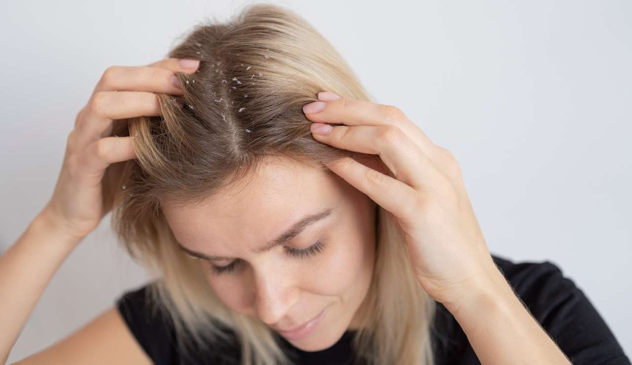 Forfora, l’unico metodo funzionante per evitare l’EFFETTO NEVE | Lavarli 2 volte al giorno non serve a niente